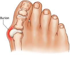 Bunion Diagram