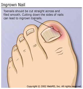 Ingrown Nail Diagram: Toenails should be cut straight across and filed smooth. Cutting down the sides of the nails can lead to ingrown toenails.