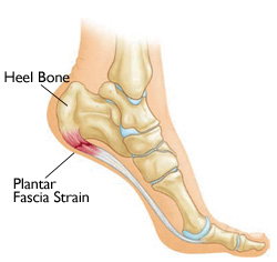 Plantar Fasciitis Diagram - Heel Bone & Plantar Fascia Strain
